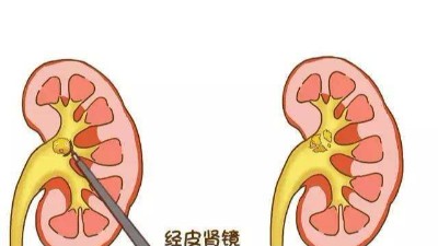 腎結石早查早治無風險 久拖不治成大患