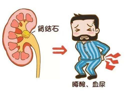 腎結(jié)石有什么癥狀
